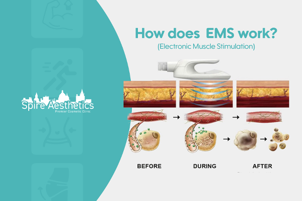 EMS treatment for post pregnancy weight loss treatment Buckingham