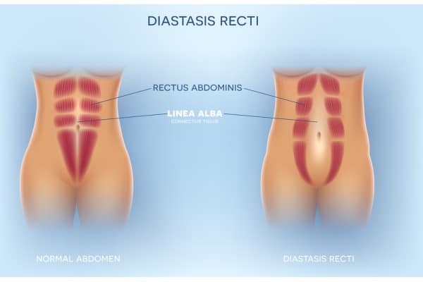 What Non-Surgical Options Are Available for Diastasis Recti Buckingham?