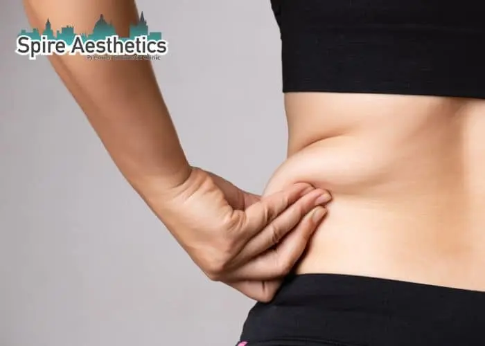 Image of woman pinching fat on their hips Buckingham. Fat Freezing treatment 