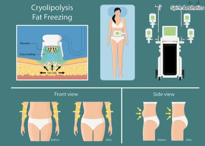 Image of diet and fat freezing combined for best results for Spire Aesthetics Buckingham