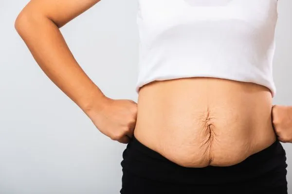 Image of a woman's stomach after weight loss with sagging skin following a gastric band Buckingham