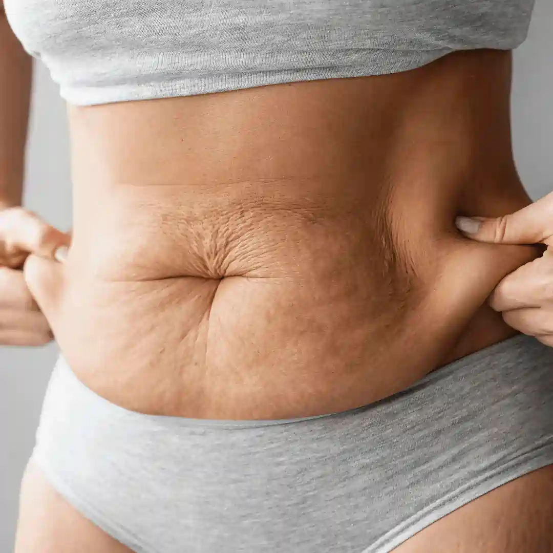 Is It Normal to Have Loose Skin After Pregnancy Buckingham?