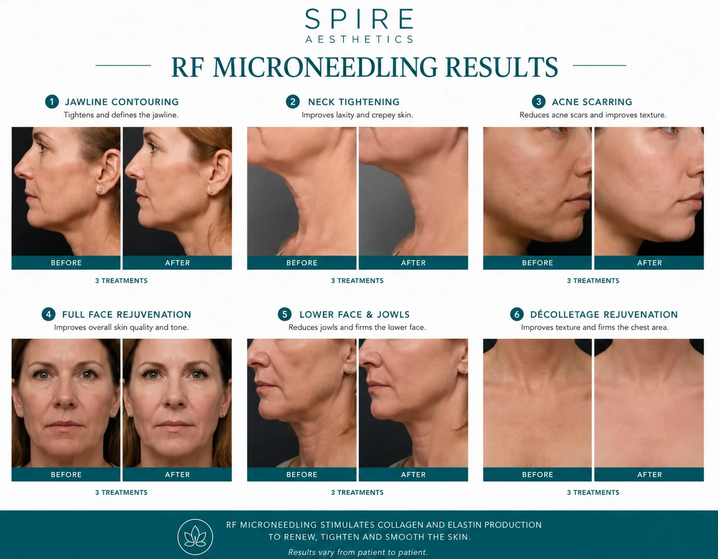 RF Microneedling Skin tightening Buckingham results