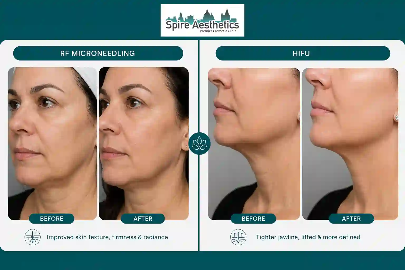 Can RF Microneedling and HIFU Be Combined Buckingham?