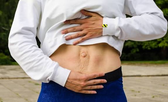 When Could Diastasis Recti Be the Missing Piece of the Puzzle Buckingham?