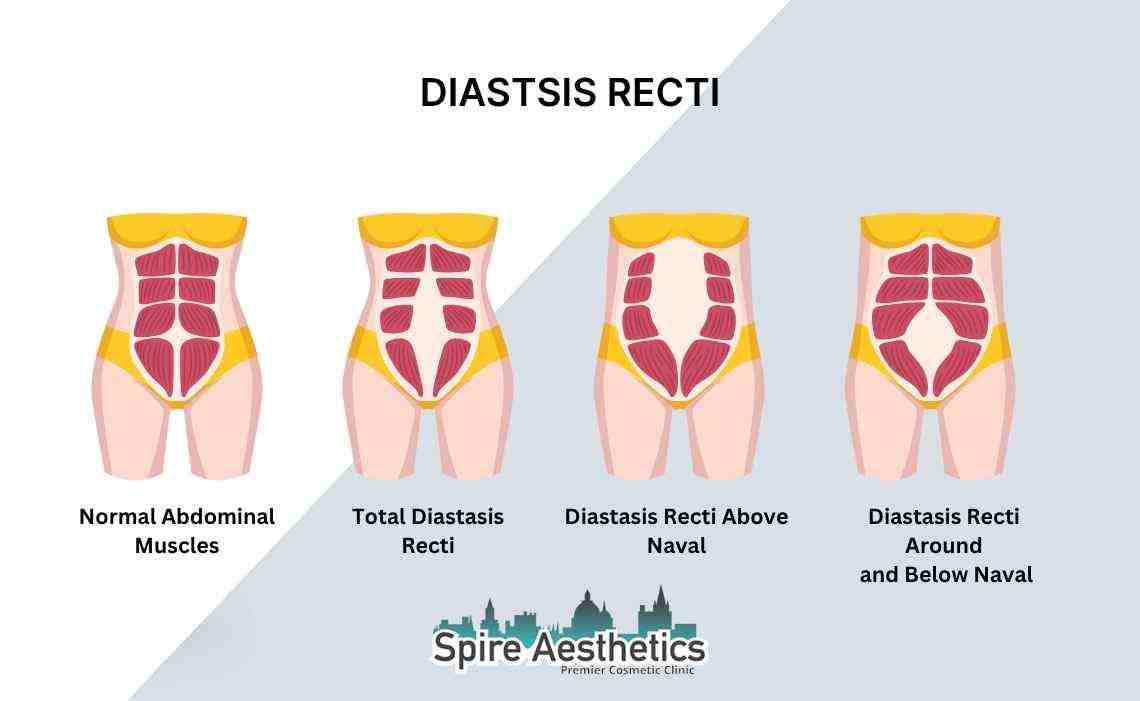 Is Non-Surgical Diastasis Recti Treatment Right for You? Common Concerns Answered Buckingham